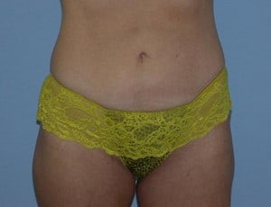 Liposuction after