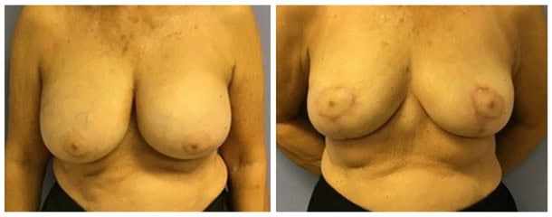 Breast Implant Removal in Tampa