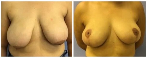Breast Lift Surgery Tampa 1 breast lift Tampa