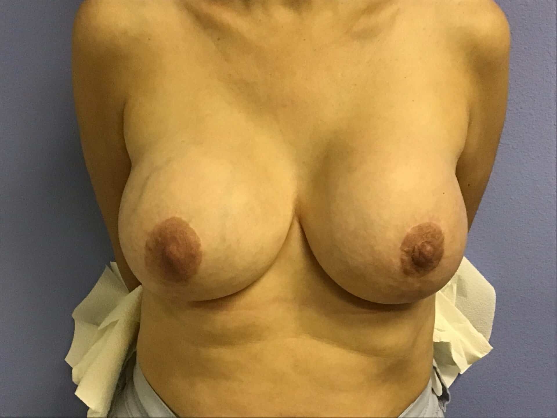 Breast Implant Removal after