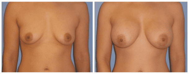 Breast Augmentation Case-103