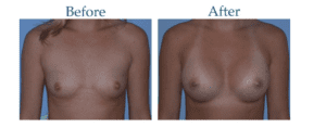 Breast augmentation symmetry