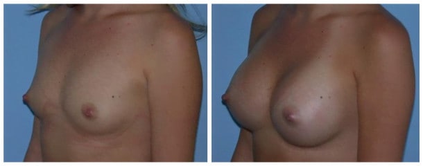 Breast Augmentation Case 101