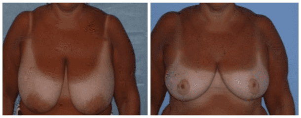 Case-102 Breast Reduction