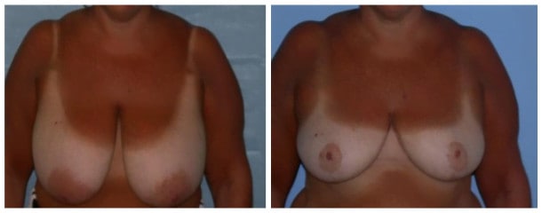 Breast Reduction Case 102