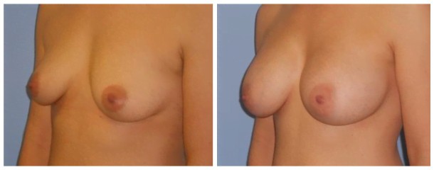 breast augmentation case 103