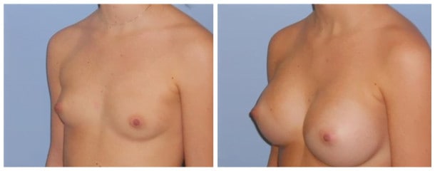 breast augmentation case 104