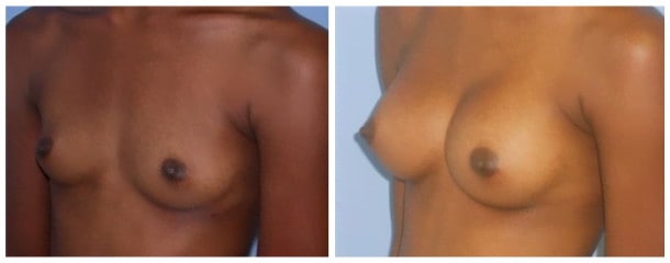 breast augmentation case 105