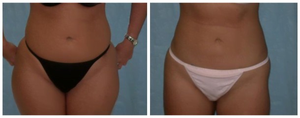 Case-107-Liposuction