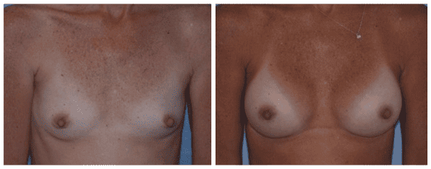 Case-108 Breast Augmentation
