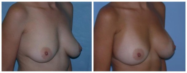 breast augmentation case