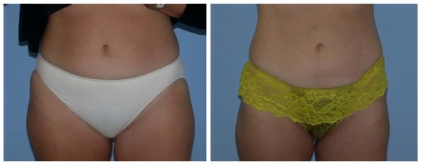 liposuction case 110