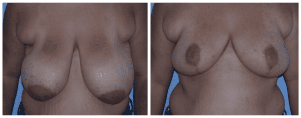 Case-111 Breast Reduction
