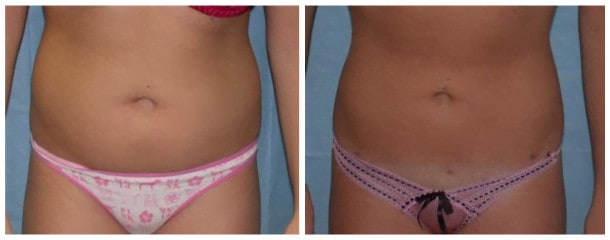 liposuction case 112 Liposuction