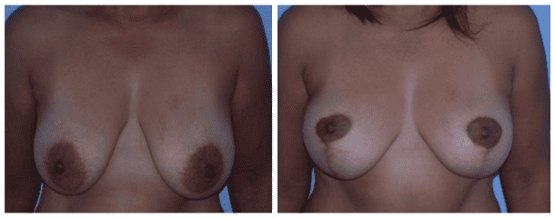 Breast Lift 117