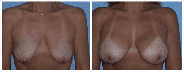 Case-119 Breast Augmentation