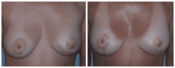 Case-121 Breast Lift