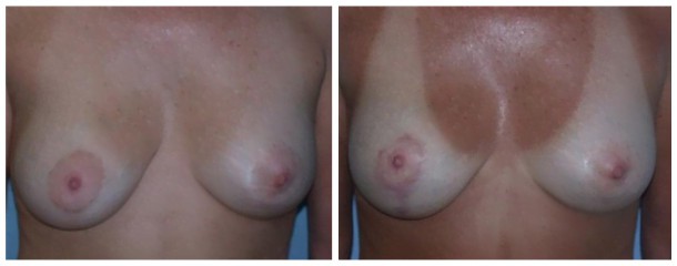 Case-121-Breast-Lift
