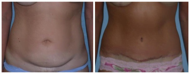 Case-124-Tummy-Tuck