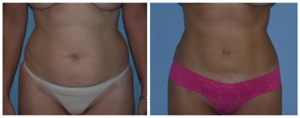 Case-126-Liposuction