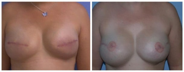 Case-131-Breast-Reconstruction