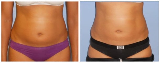 liposuction Case 132-Liposuction