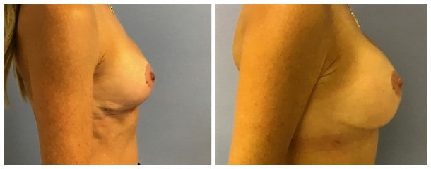 breast augmentation case