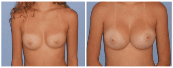 Case-135 Breast Augmentation