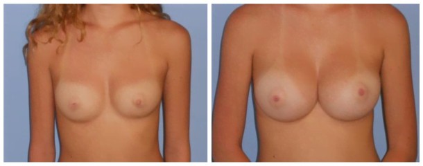 breast augmentation case 135