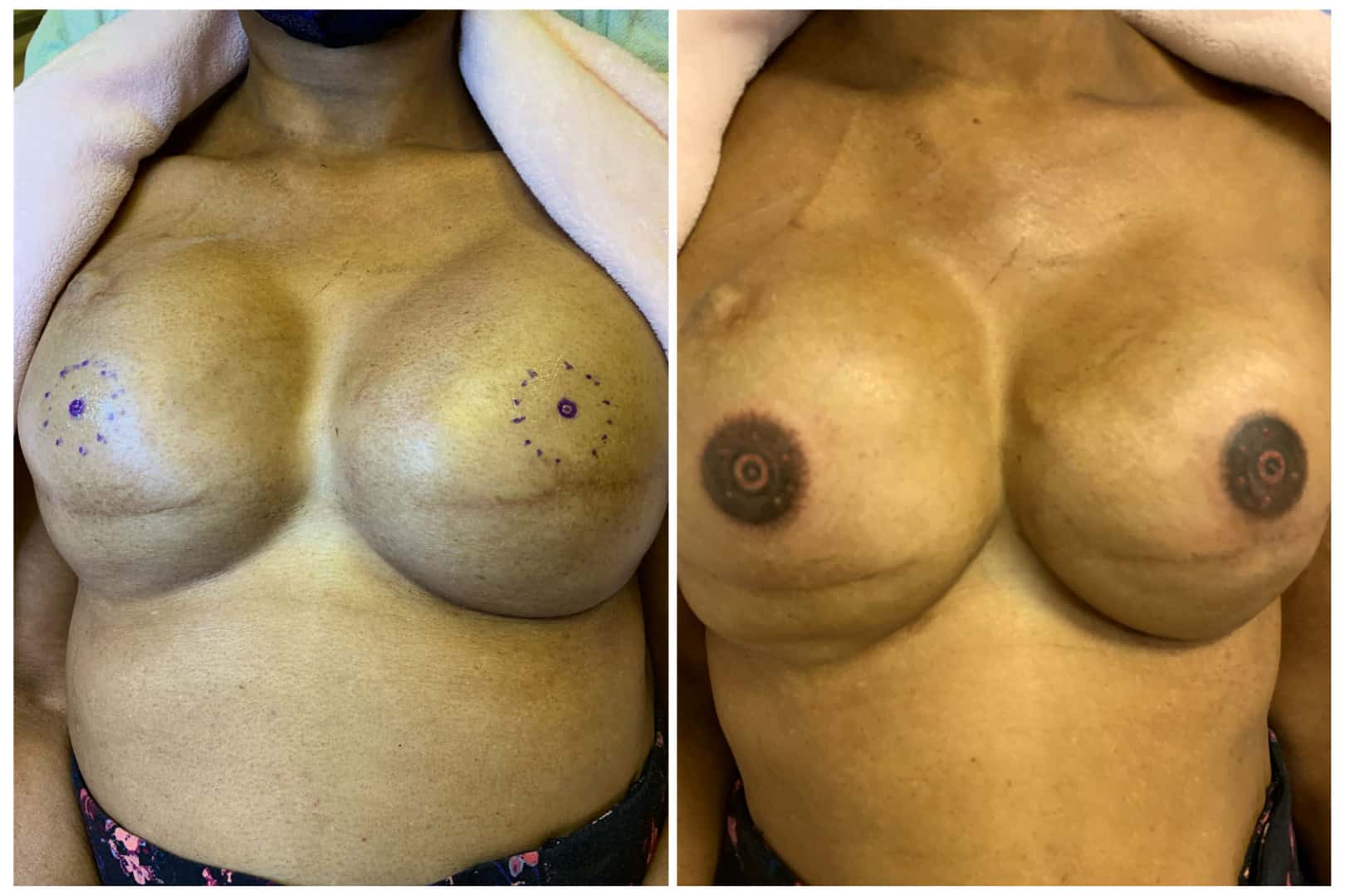 Case-136-Breast-Reconstruction