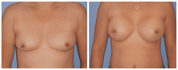 Breast Augmentation