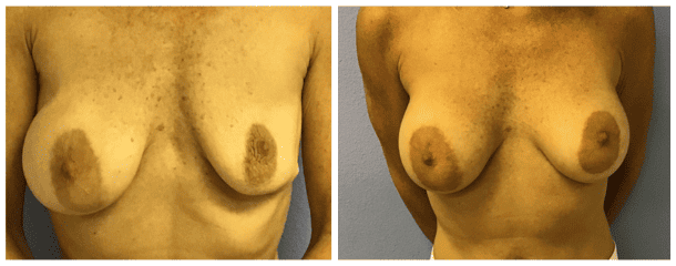 Breast Implant Exchange 1 Breast Implant Revision 8523 - Tampa Palms Plastic Surgery, Breast Implant Exchange