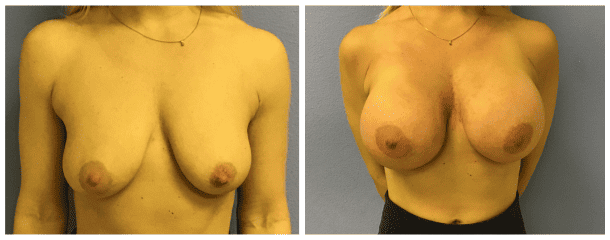 Breast Augmentation 9409