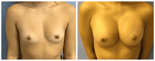 Breast Augmentation