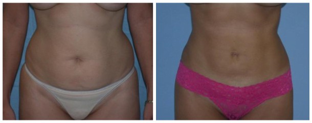 Mommy-Makeover-Case-128