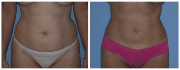 Mommy Makeover Case-128