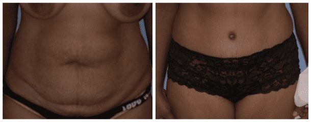 Tummy Tuck Case-118