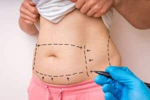 Winter is the perfect time to get the ideal summer body with Liposuction Procedure