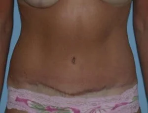 Tummy Tuck after