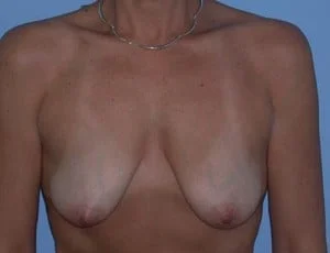 Breast Augmentation before
