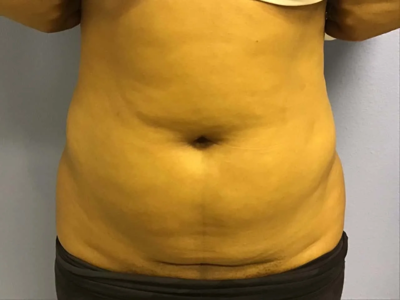 Mini Tummy Tuck before