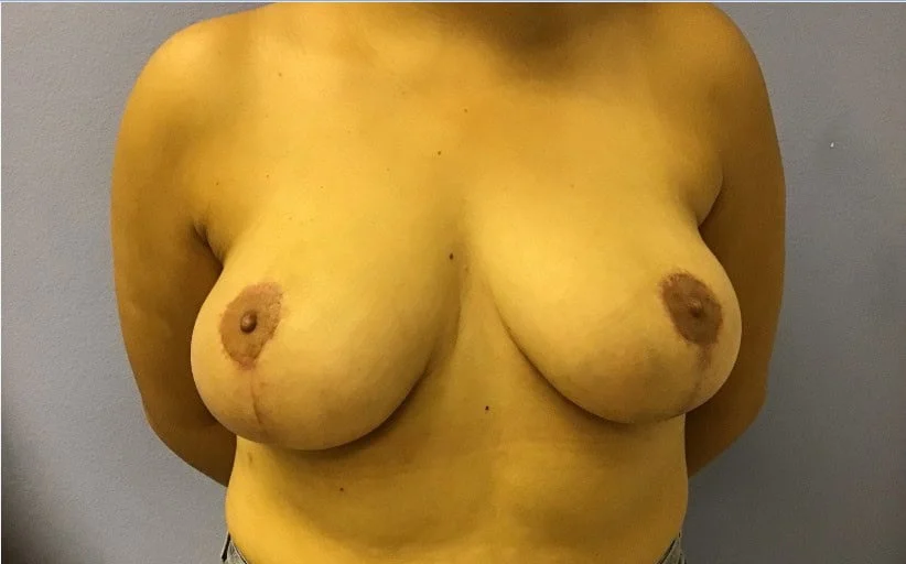 Breast Lift after