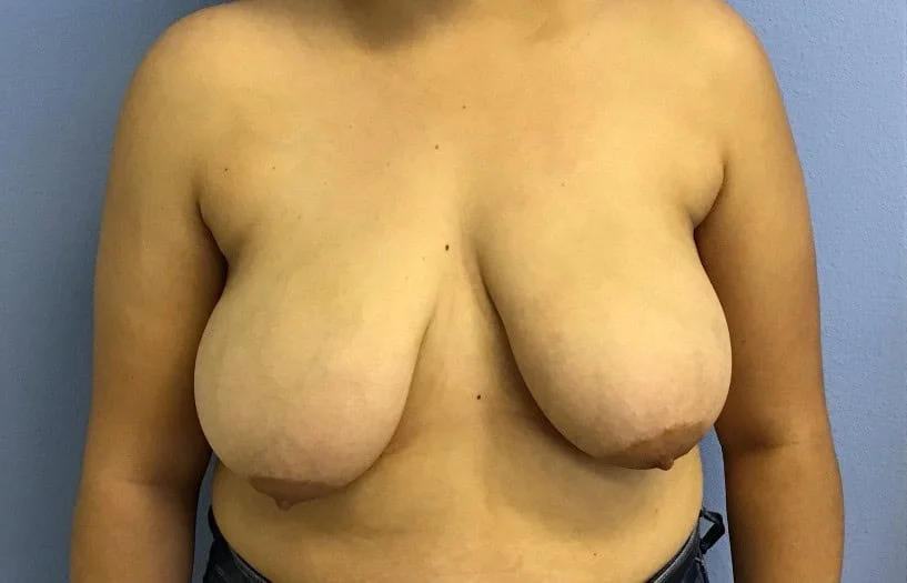 Breast Lift before