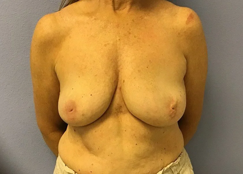 Breast Implant Removal after