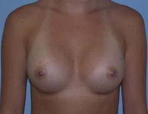 Breast Augmentation after