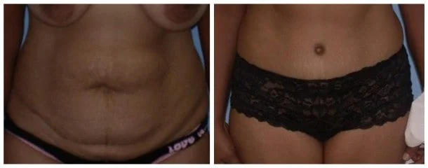 Before and after tummy tuck for body contouring after weight loss in Tampa, FL