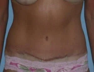 after267 Tummy Tuck Tampa Palm Plastic Surgery Group after267 Tummy Tuck Tampa Palm Plastic Surgery Group