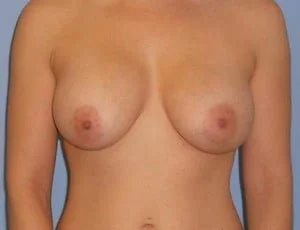 Breast Augmentation after