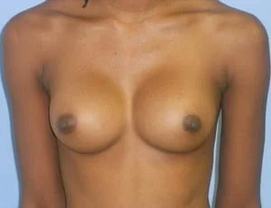 Breast Augmentation after