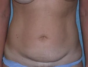 Tummy Tuck before